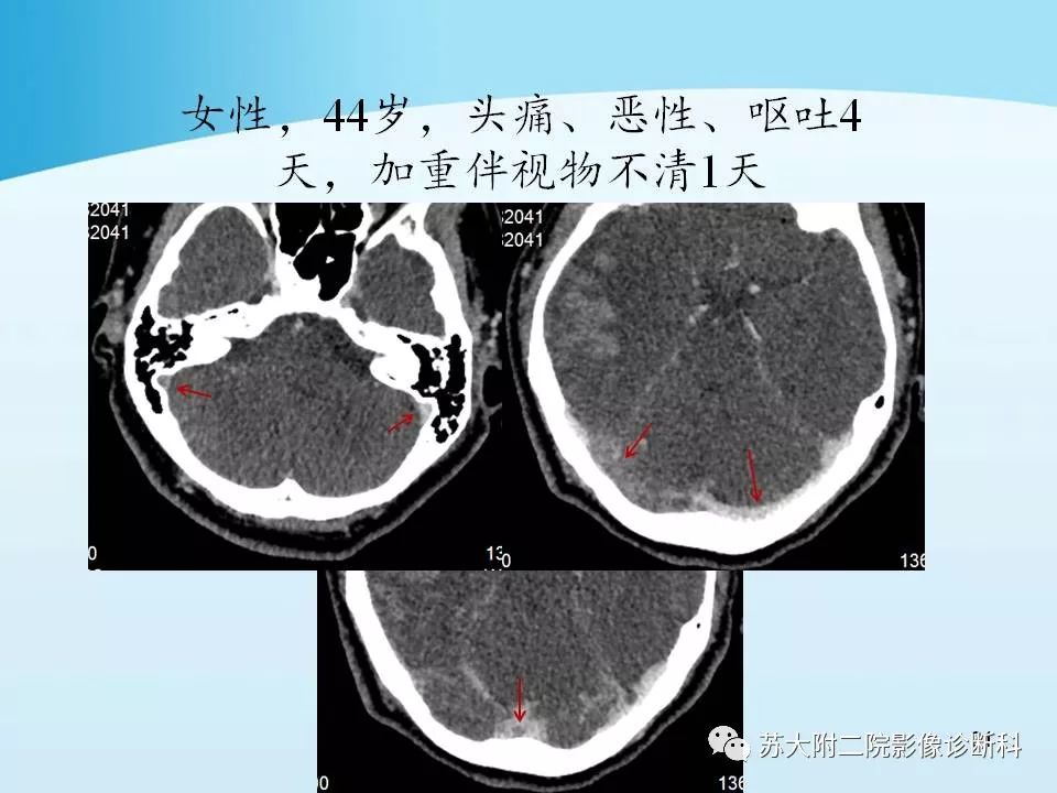影像PPT - 【PPT】脑静脉血栓影像征象分析-21
