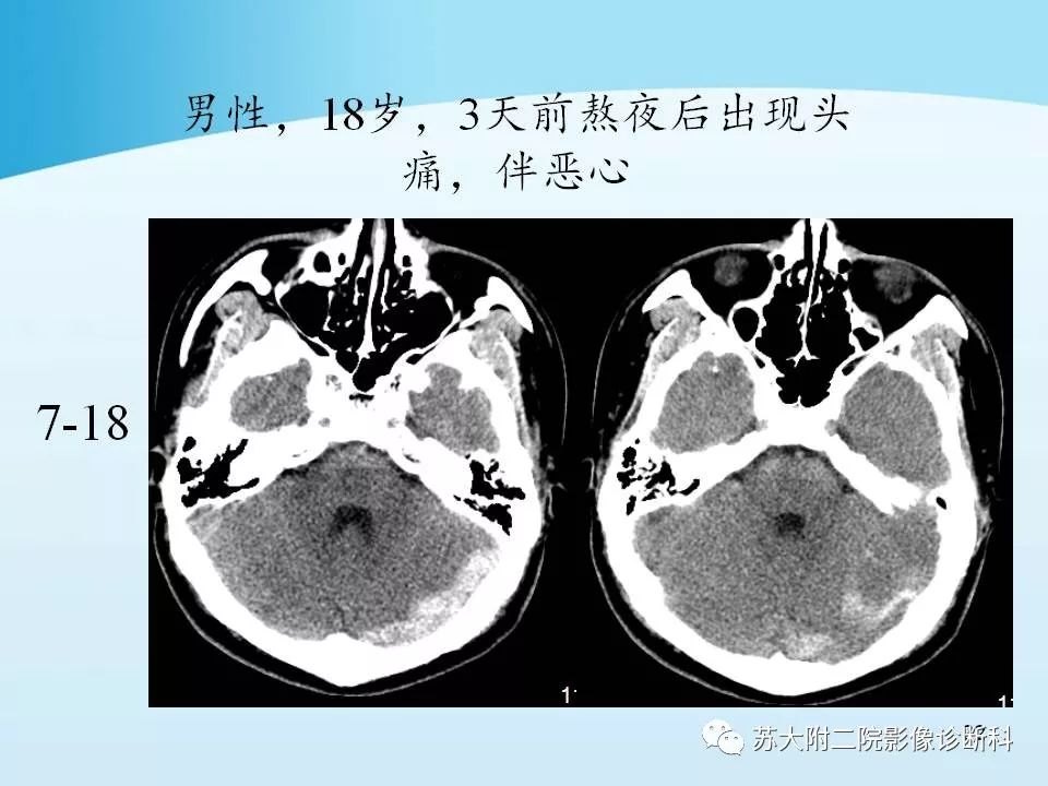 影像PPT - 【PPT】脑静脉血栓影像征象分析-22