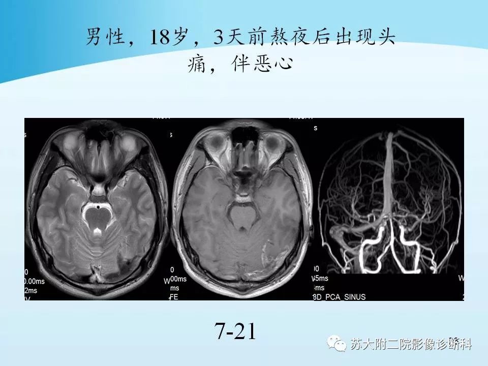 影像PPT - 【PPT】脑静脉血栓影像征象分析-23