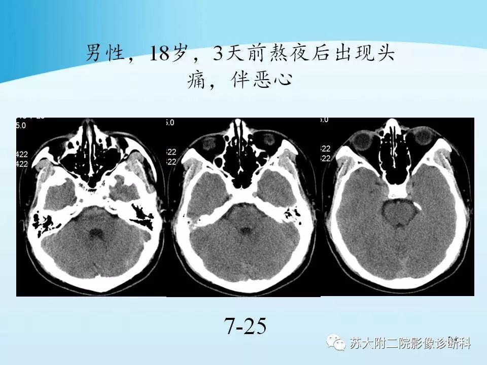 影像PPT - 【PPT】脑静脉血栓影像征象分析-24