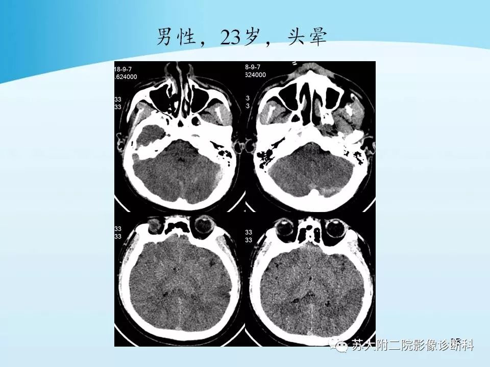 影像PPT - 【PPT】脑静脉血栓影像征象分析-25