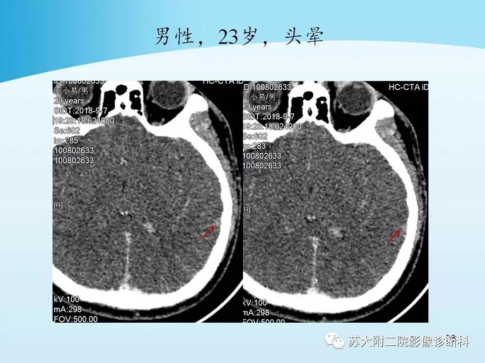 影像PPT - 【PPT】脑静脉血栓影像征象分析-26