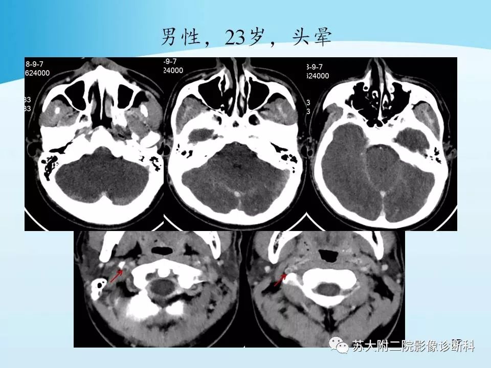 影像PPT - 【PPT】脑静脉血栓影像征象分析-27