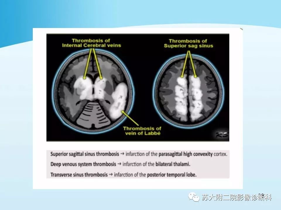 影像PPT - 【PPT】脑静脉血栓影像征象分析-28