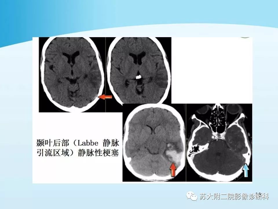 影像PPT - 【PPT】脑静脉血栓影像征象分析-33