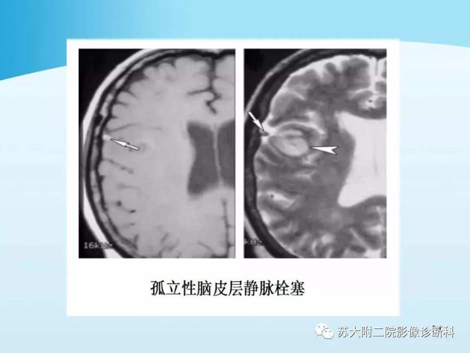 影像PPT - 【PPT】脑静脉血栓影像征象分析-34