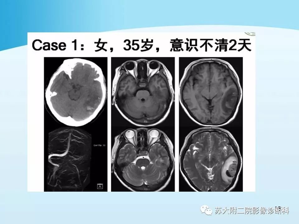 影像PPT - 【PPT】脑静脉血栓影像征象分析-35