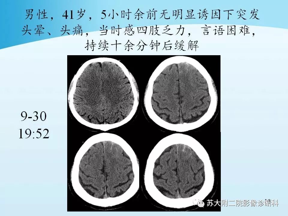 影像PPT - 【PPT】脑静脉血栓影像征象分析-36