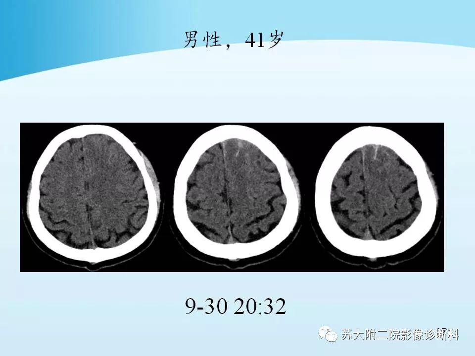 影像PPT - 【PPT】脑静脉血栓影像征象分析-37
