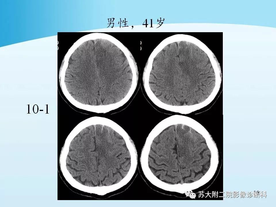 影像PPT - 【PPT】脑静脉血栓影像征象分析-38