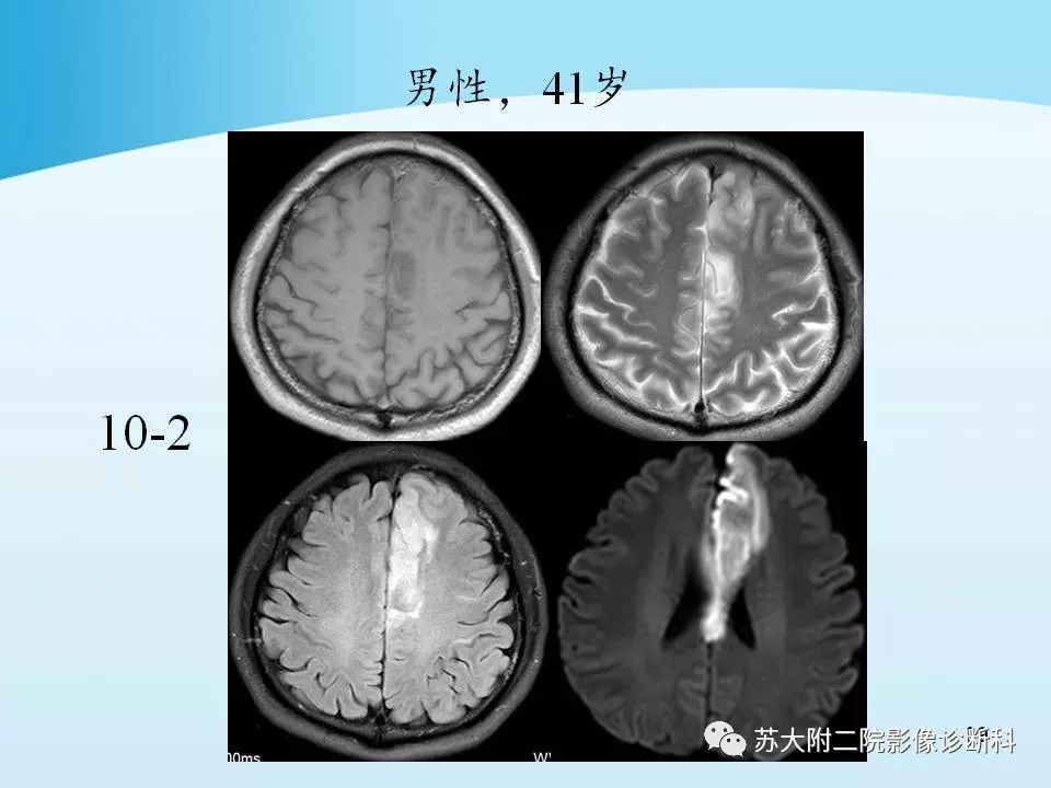 影像PPT - 【PPT】脑静脉血栓影像征象分析-39