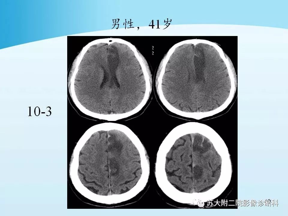 影像PPT - 【PPT】脑静脉血栓影像征象分析-40