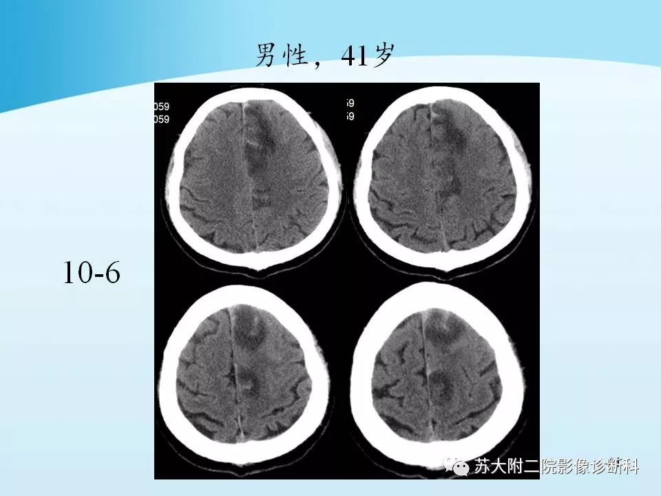 影像PPT - 【PPT】脑静脉血栓影像征象分析-41