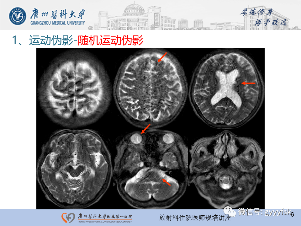 影像PPT - 【PPT】磁共振成像中的常见伪影及避免方法-6