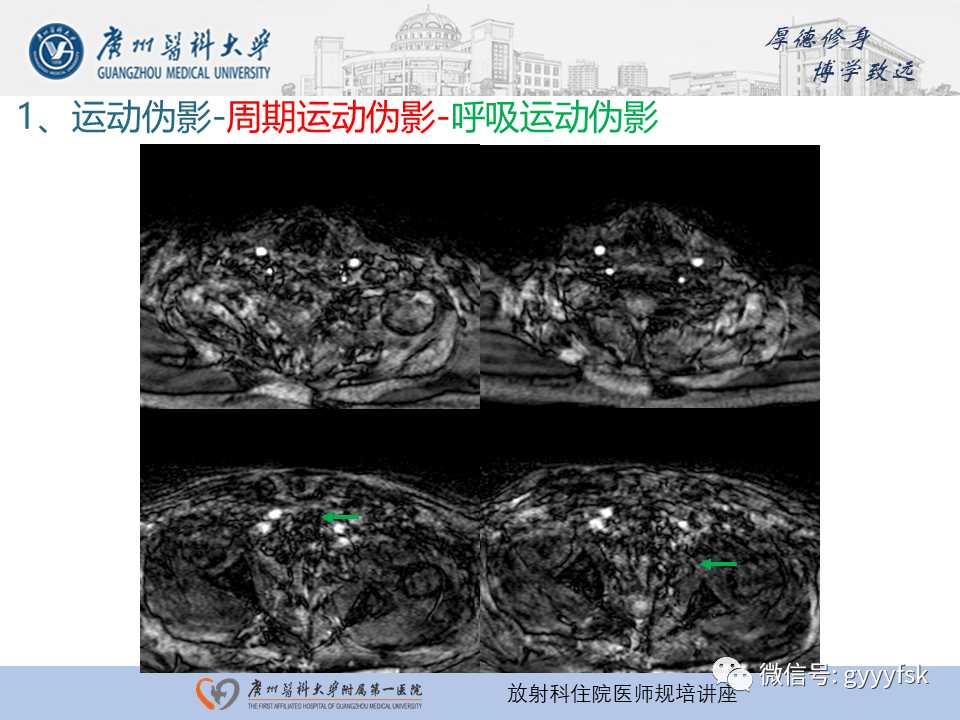 影像PPT - 【PPT】磁共振成像中的常见伪影及避免方法-10