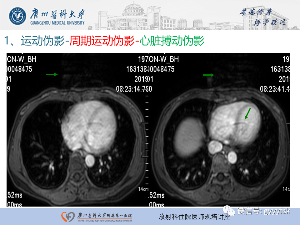影像PPT - 【PPT】磁共振成像中的常见伪影及避免方法-12