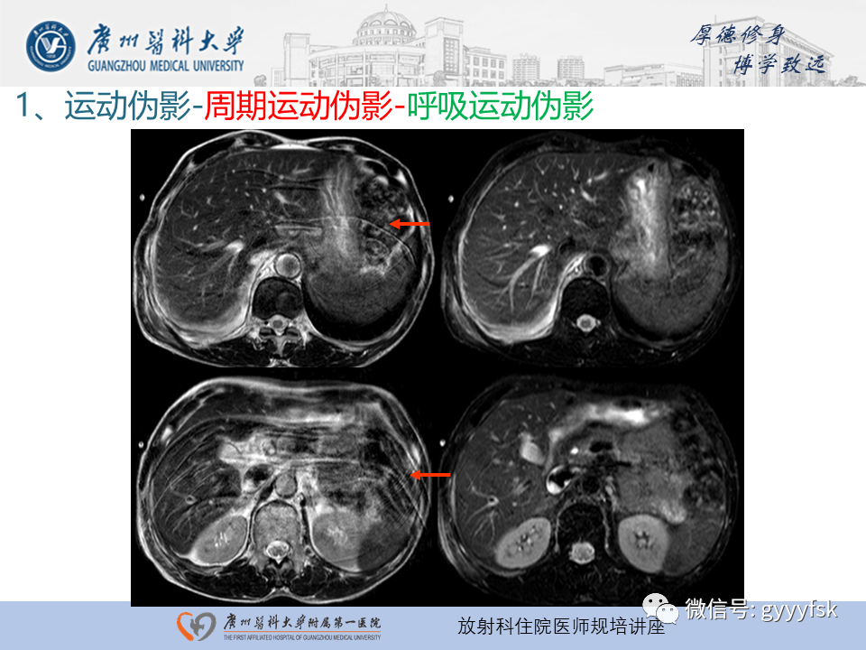 影像PPT - 【PPT】磁共振成像中的常见伪影及避免方法-11