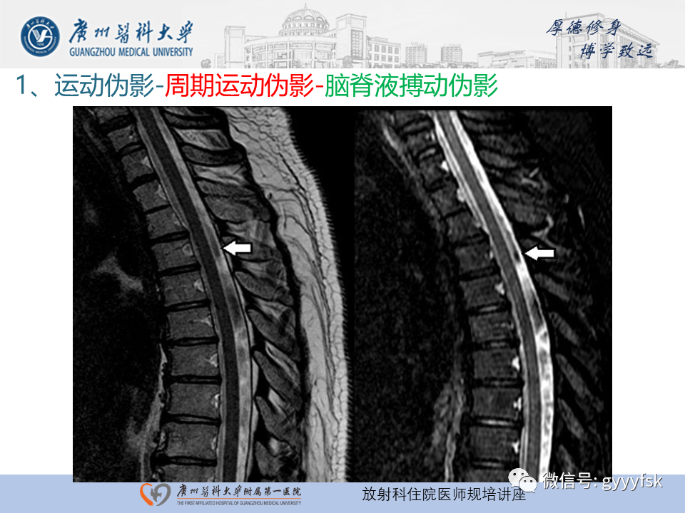 影像PPT - 【PPT】磁共振成像中的常见伪影及避免方法-14