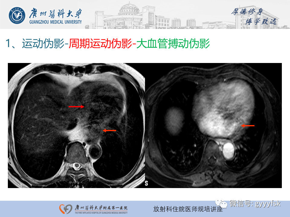 影像PPT - 【PPT】磁共振成像中的常见伪影及避免方法-4