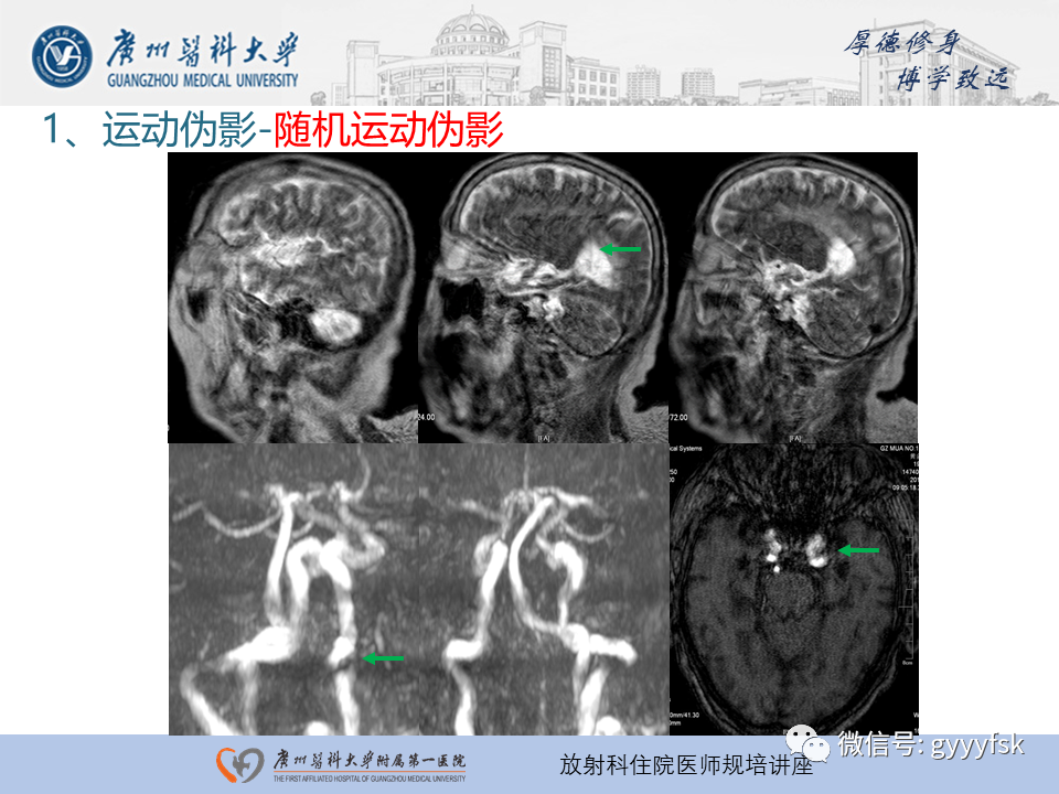 影像PPT - 【PPT】磁共振成像中的常见伪影及避免方法-3