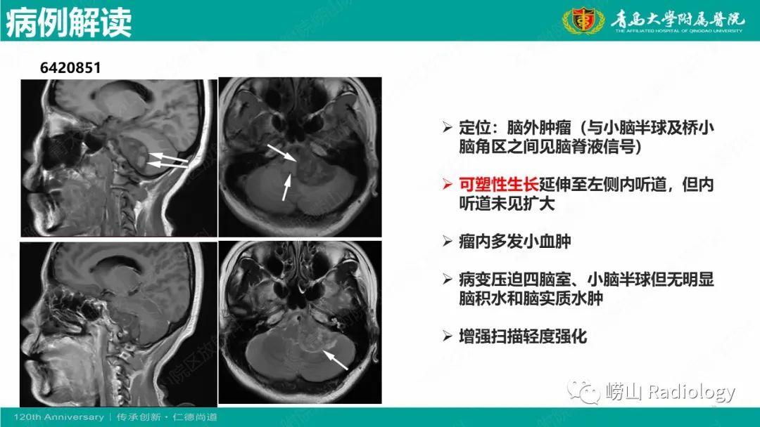 影像PPT - 【病例】桥小脑角区乳头型室管膜瘤1例CT及MR影像-10