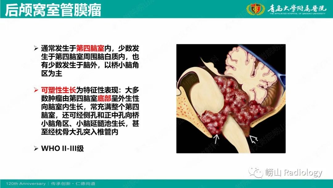 影像PPT - 【病例】桥小脑角区乳头型室管膜瘤1例CT及MR影像-15