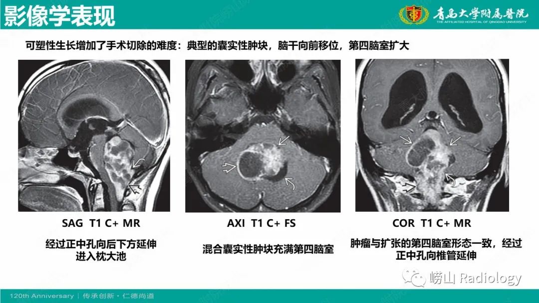 影像PPT - 【病例】桥小脑角区乳头型室管膜瘤1例CT及MR影像-17