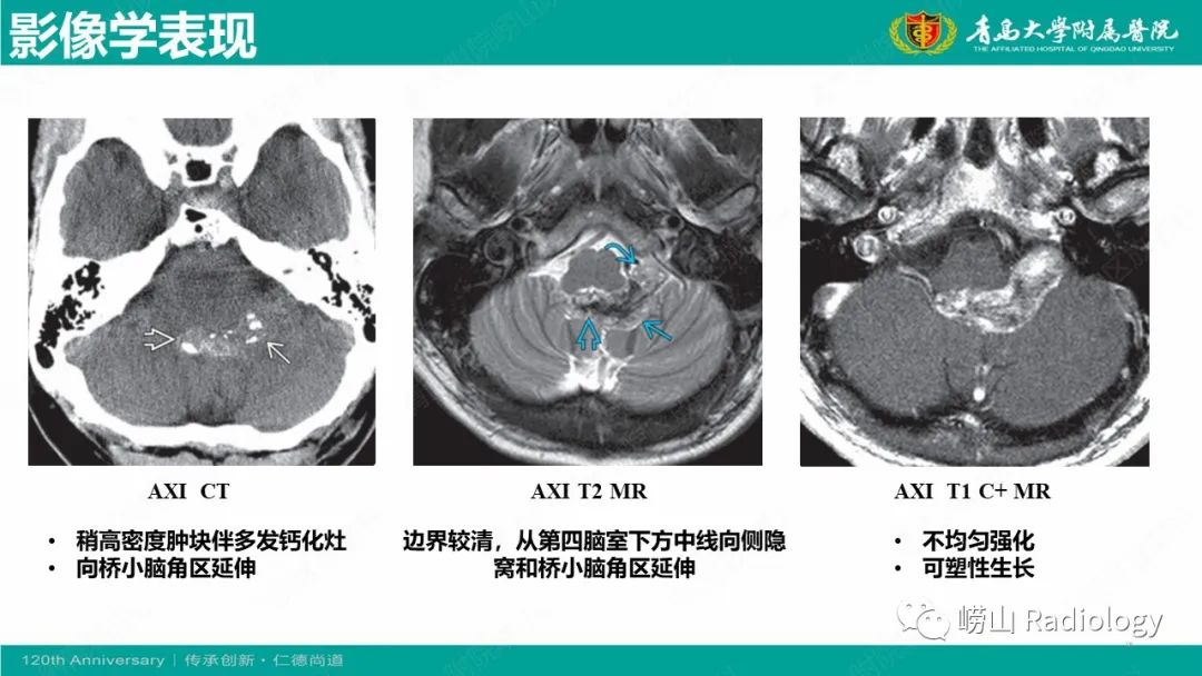 影像PPT - 【病例】桥小脑角区乳头型室管膜瘤1例CT及MR影像-18