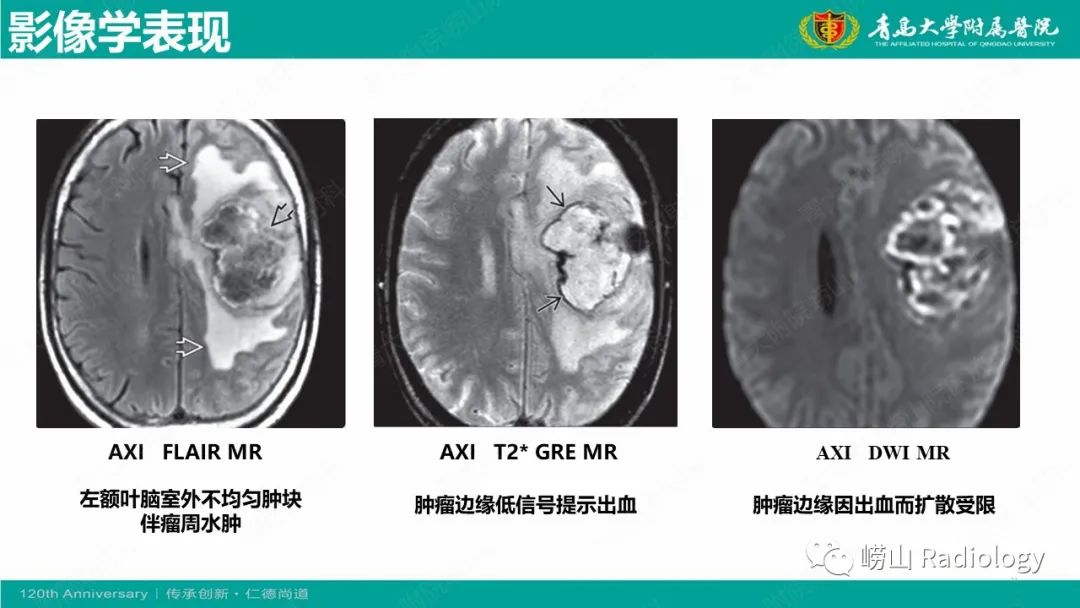 影像PPT - 【病例】桥小脑角区乳头型室管膜瘤1例CT及MR影像-21