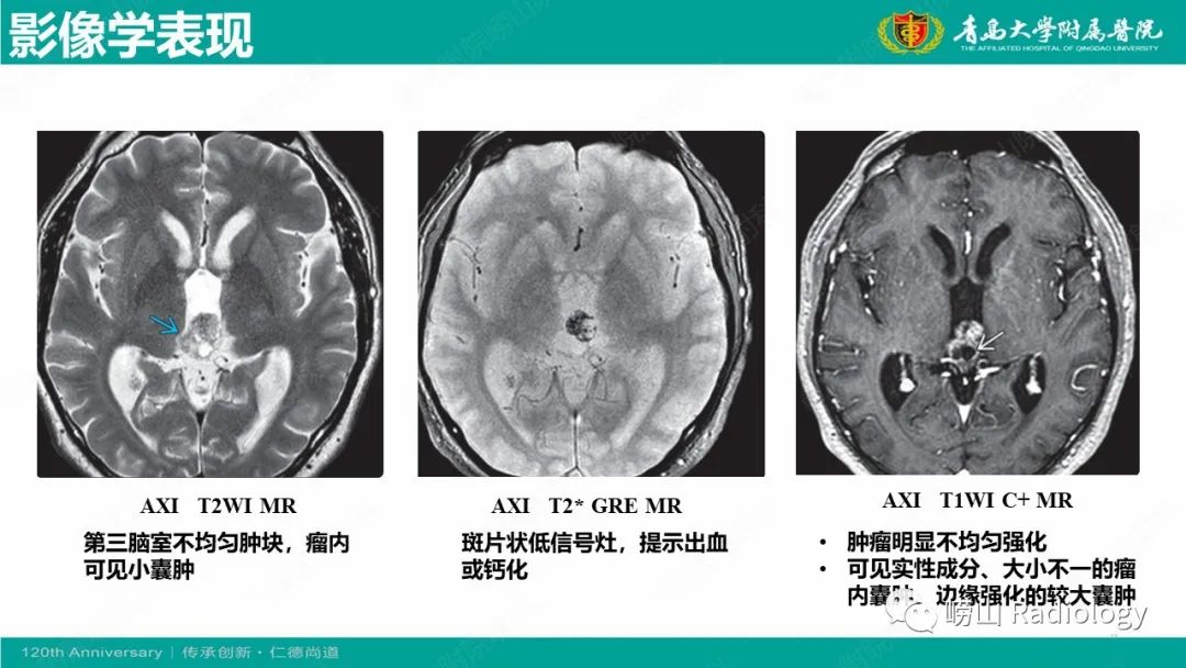 影像PPT - 【病例】桥小脑角区乳头型室管膜瘤1例CT及MR影像-22