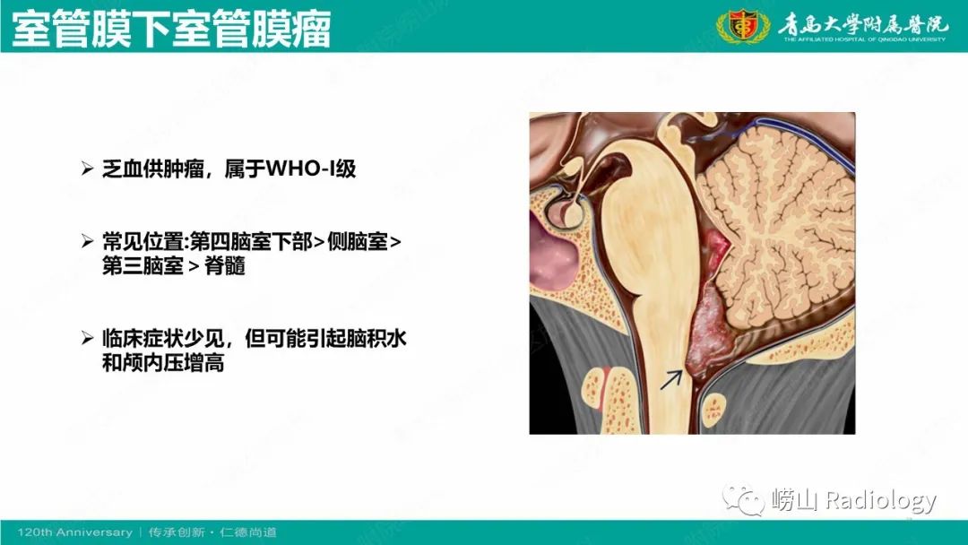 影像PPT - 【病例】桥小脑角区乳头型室管膜瘤1例CT及MR影像-23