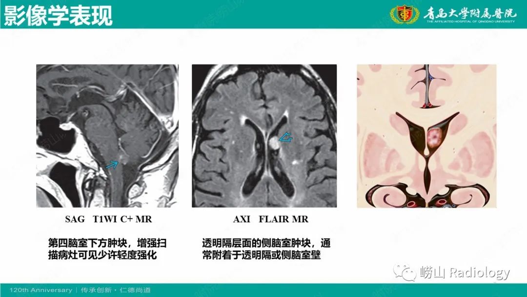 影像PPT - 【病例】桥小脑角区乳头型室管膜瘤1例CT及MR影像-25