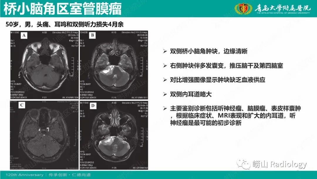 影像PPT - 【病例】桥小脑角区乳头型室管膜瘤1例CT及MR影像-26