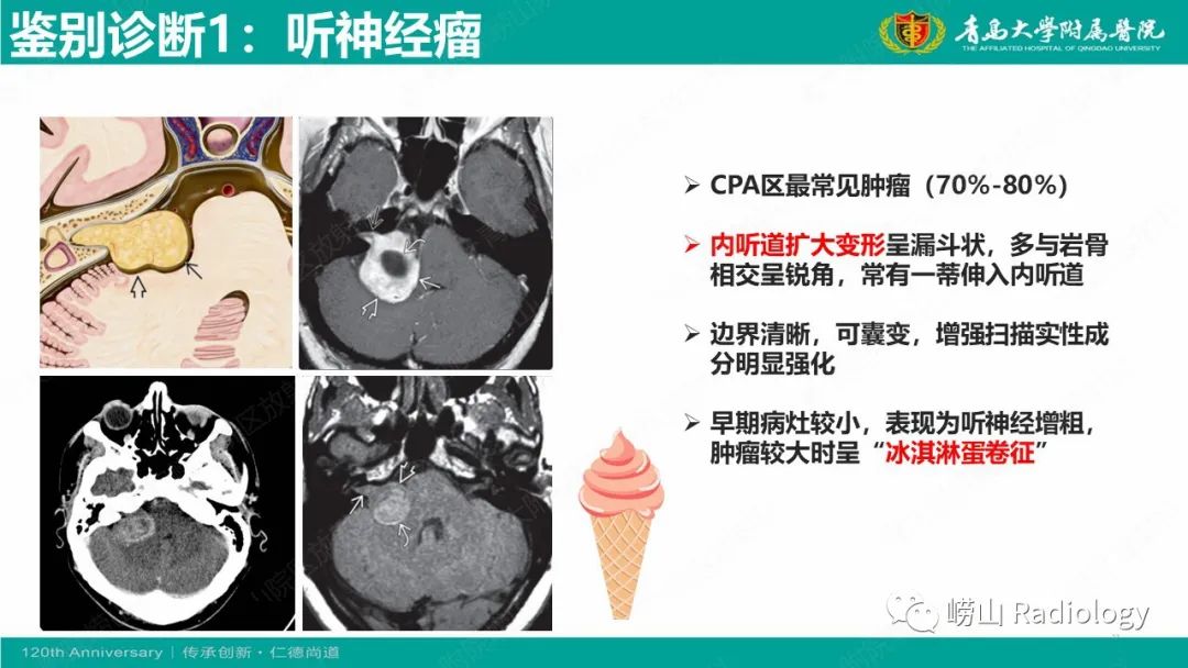 影像PPT - 【病例】桥小脑角区乳头型室管膜瘤1例CT及MR影像-27