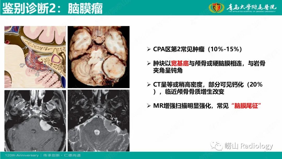 影像PPT - 【病例】桥小脑角区乳头型室管膜瘤1例CT及MR影像-28