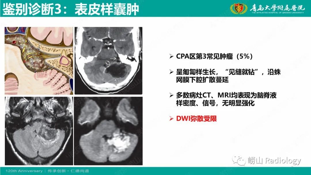 影像PPT - 【病例】桥小脑角区乳头型室管膜瘤1例CT及MR影像-29