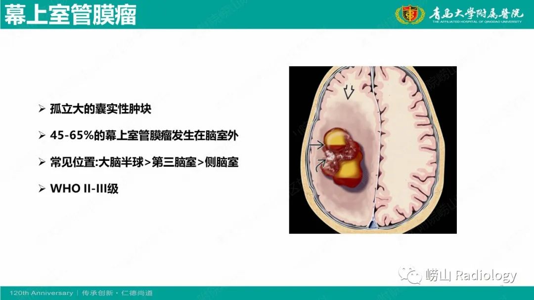 影像PPT - 【病例】桥小脑角区乳头型室管膜瘤1例CT及MR影像-5