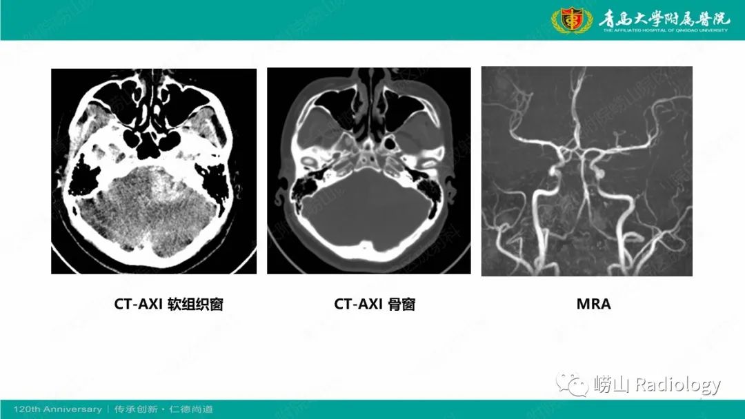 影像PPT - 【病例】桥小脑角区乳头型室管膜瘤1例CT及MR影像-2