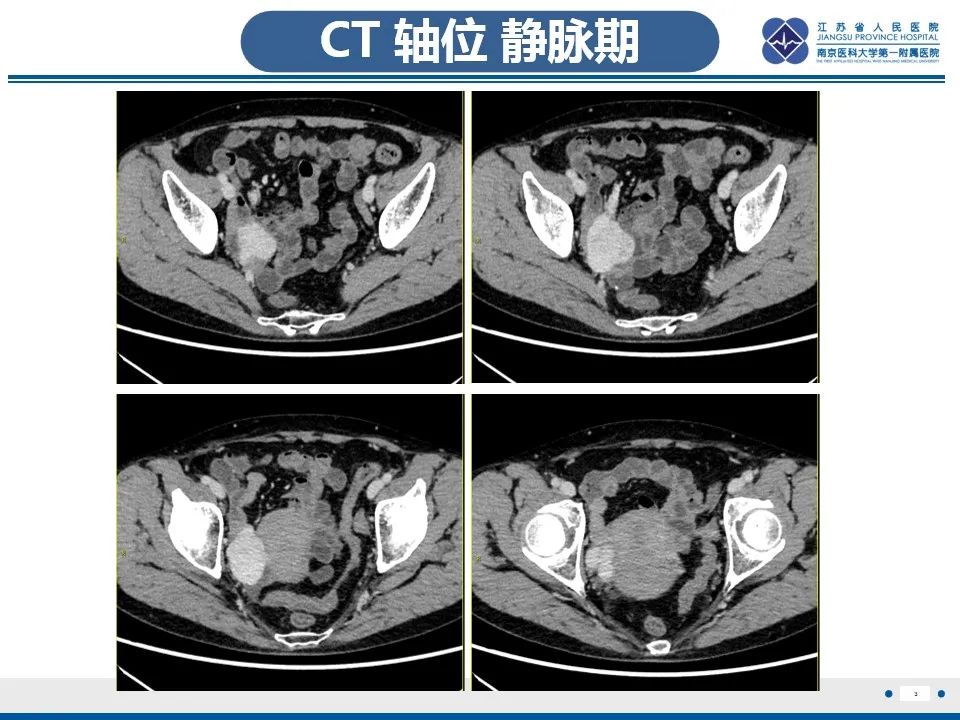 影像PPT - 【PPT】盆腔孤立性纤维瘤-4