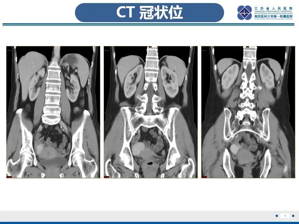 影像PPT - 【PPT】盆腔孤立性纤维瘤-5