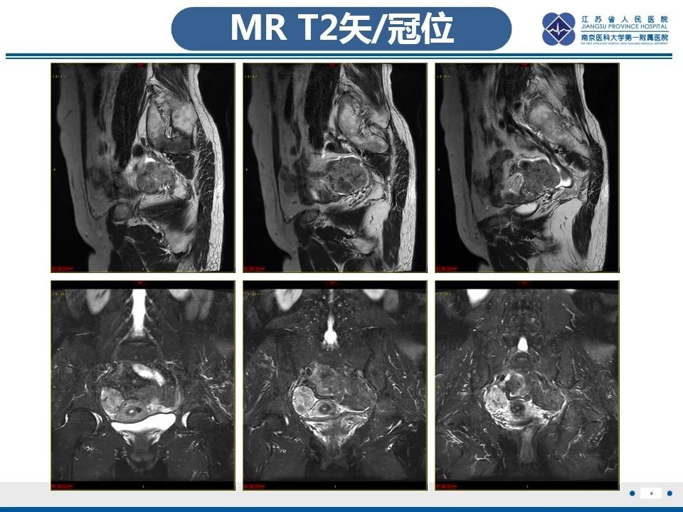 影像PPT - 【PPT】盆腔孤立性纤维瘤-7