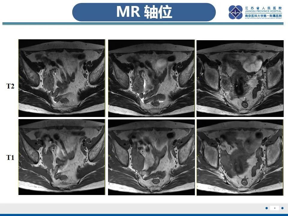 影像PPT - 【PPT】盆腔孤立性纤维瘤-6