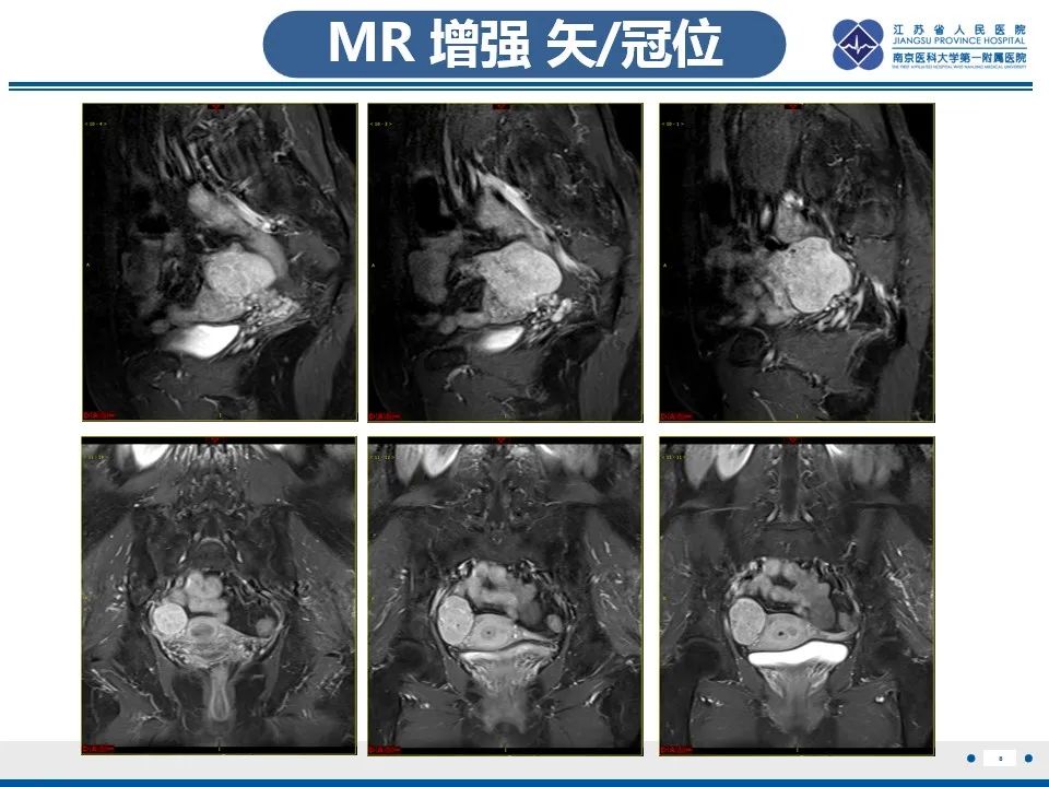 影像PPT - 【PPT】盆腔孤立性纤维瘤-9