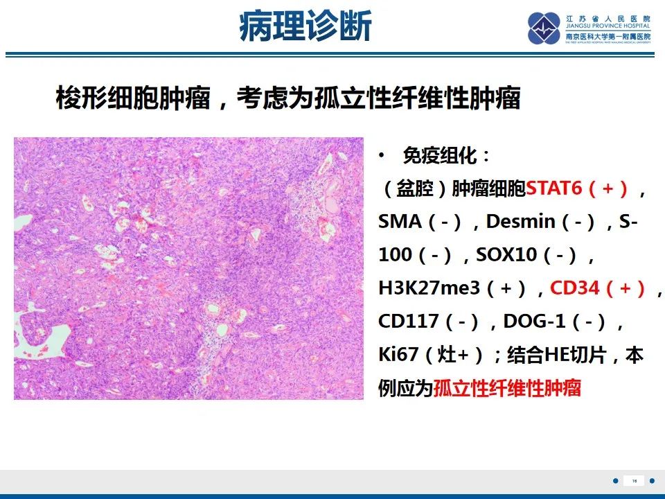 影像PPT - 【PPT】盆腔孤立性纤维瘤-17