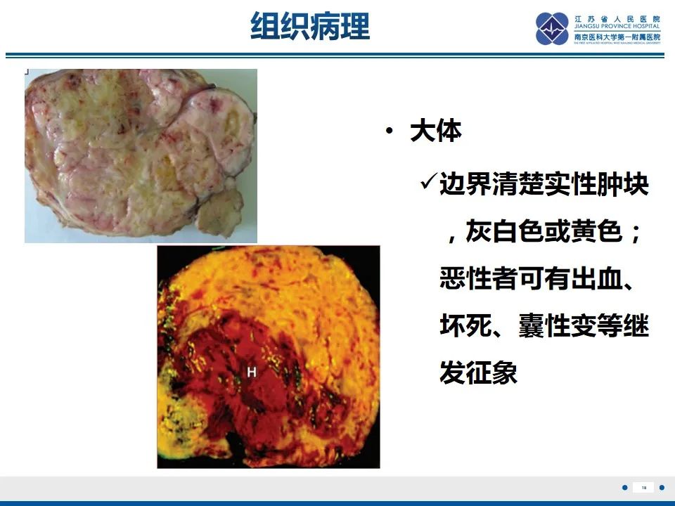 影像PPT - 【PPT】盆腔孤立性纤维瘤-19
