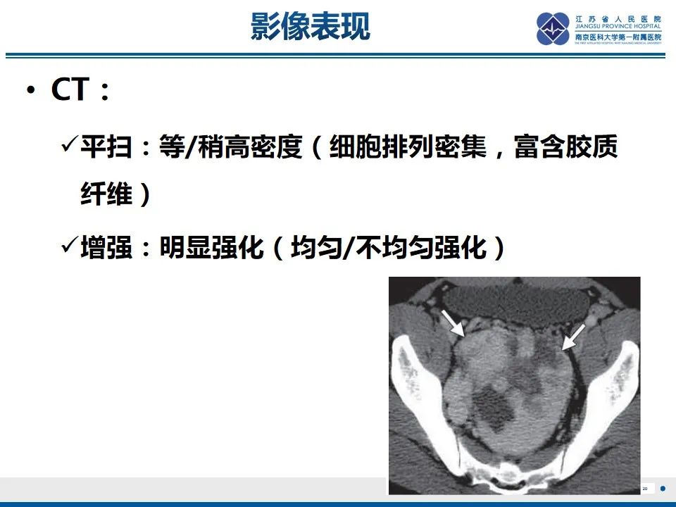 影像PPT - 【PPT】盆腔孤立性纤维瘤-21