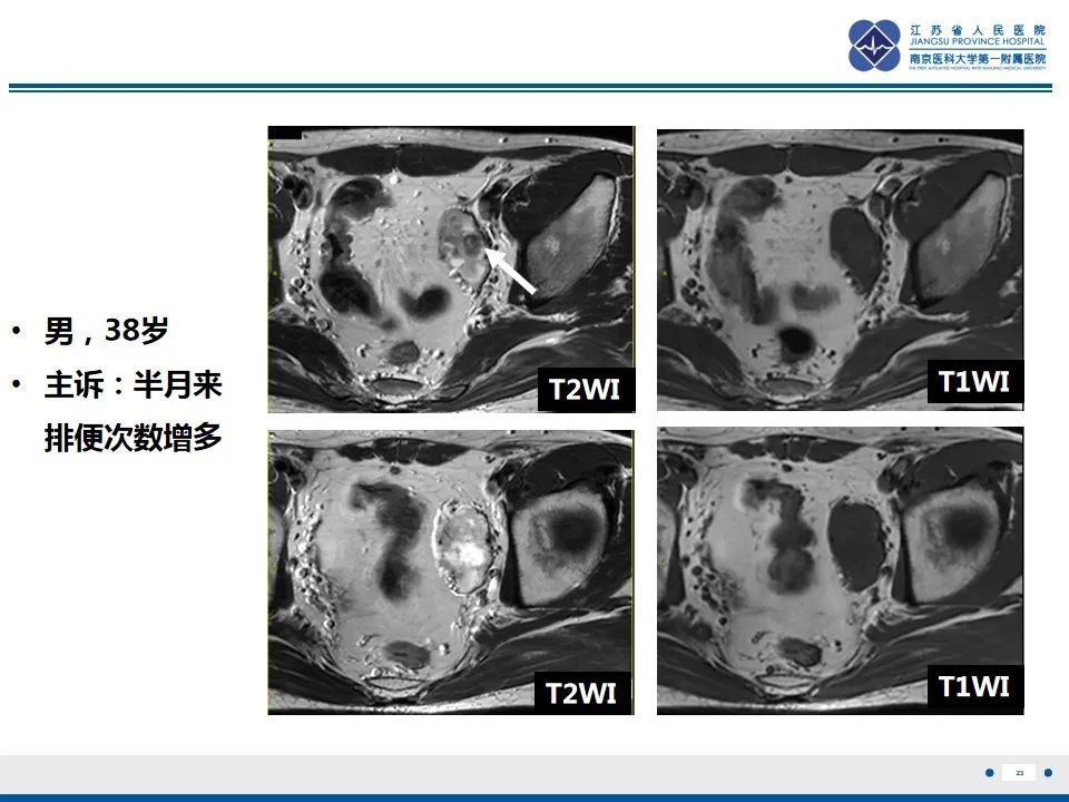 影像PPT - 【PPT】盆腔孤立性纤维瘤-24