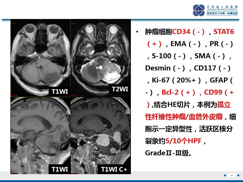 影像PPT - 【PPT】盆腔孤立性纤维瘤-31