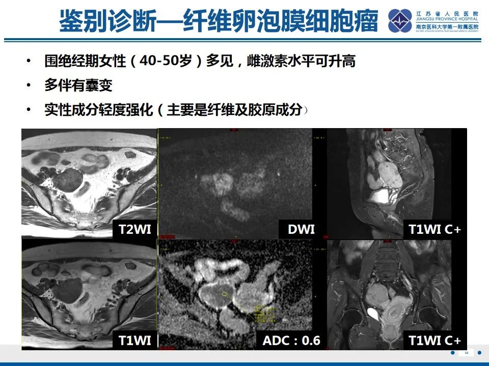 影像PPT - 【PPT】盆腔孤立性纤维瘤-34