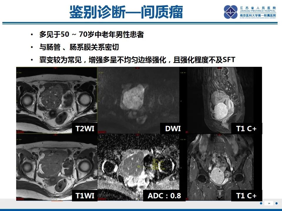 影像PPT - 【PPT】盆腔孤立性纤维瘤-35